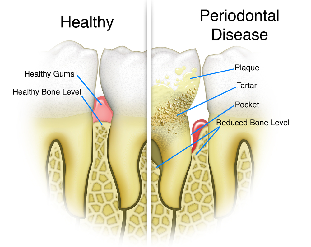 receding gums and periodontal disease