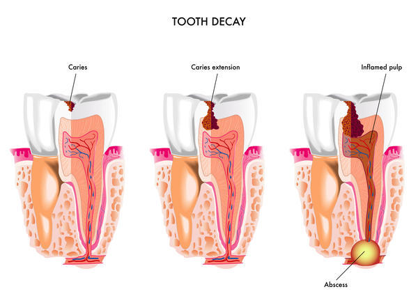 tooth extraction aftercare decay
