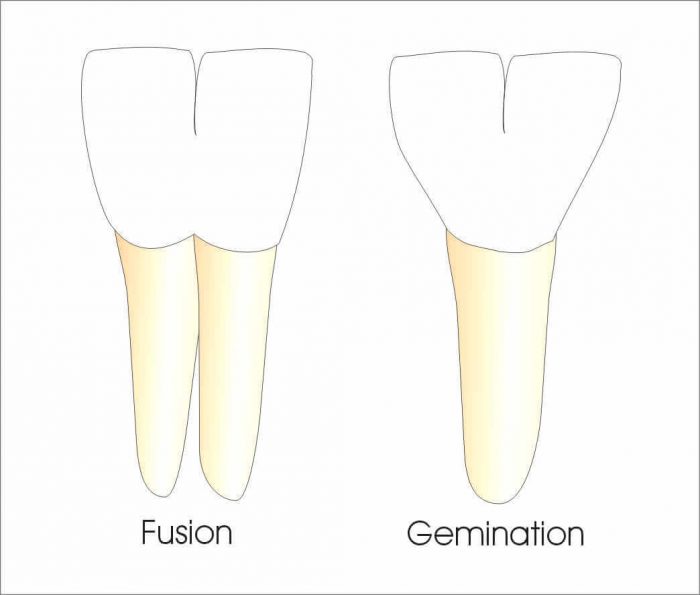 Double fused "baby" teeth: tooth gemination and tooth fusion