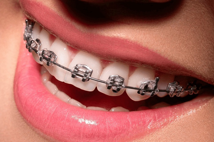 types of braces metal braces