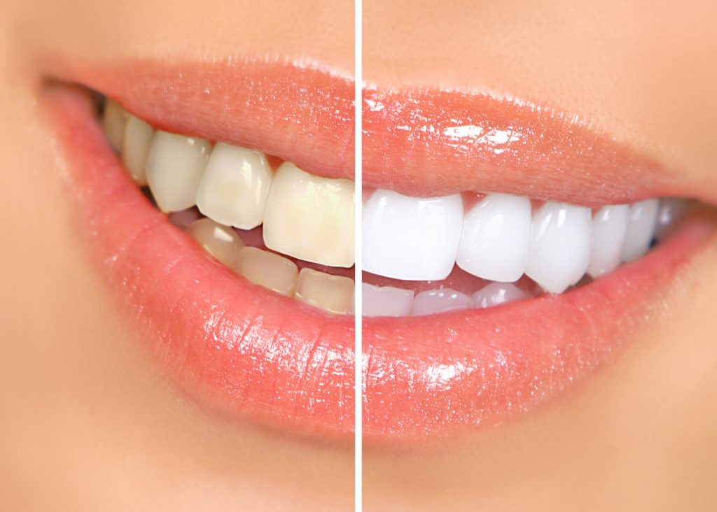 Cosmetic Dentistry teeth whitening