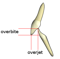 how to fix an overbite vs overjet