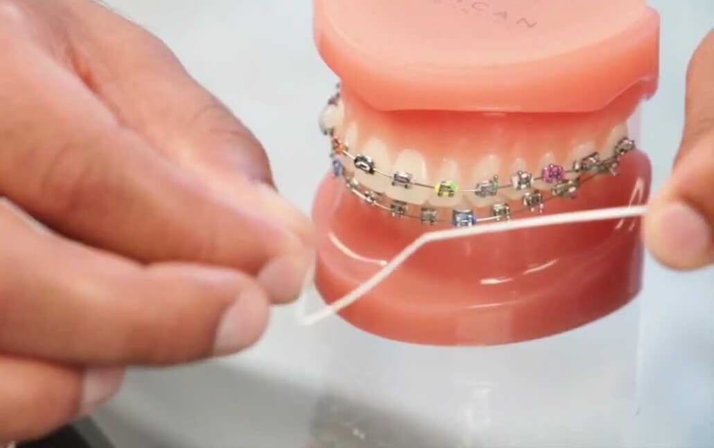 how to floss with braces method