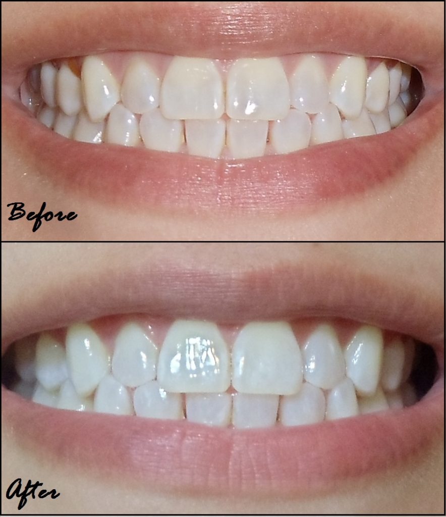 отбеливание зубов белые пятна на зубах