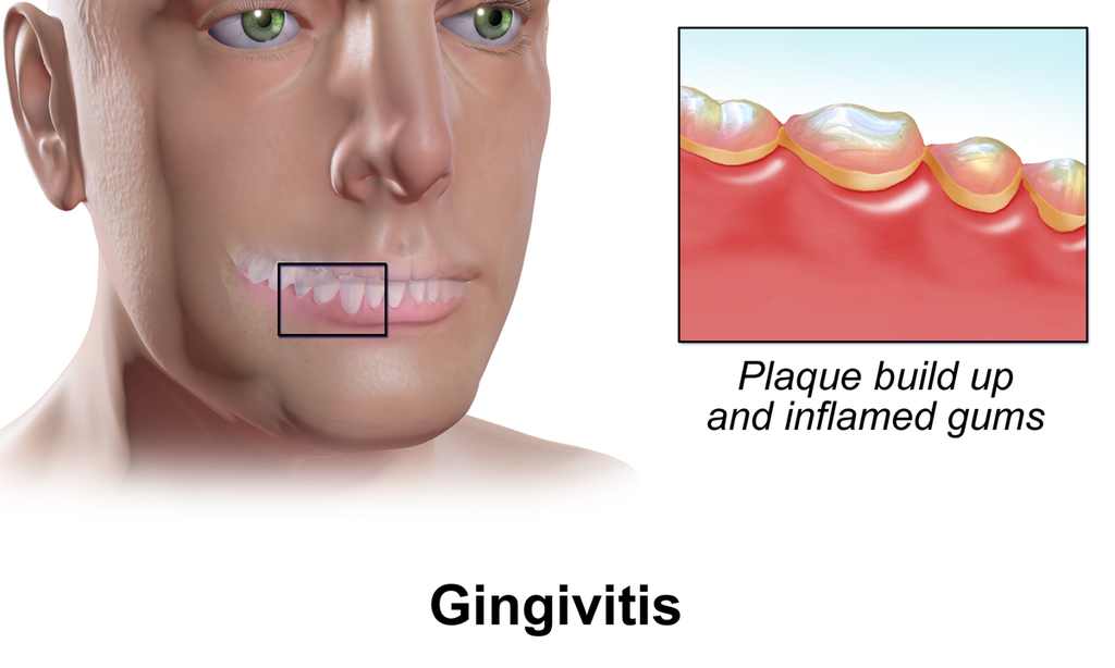 is gingivitis contagious diagram