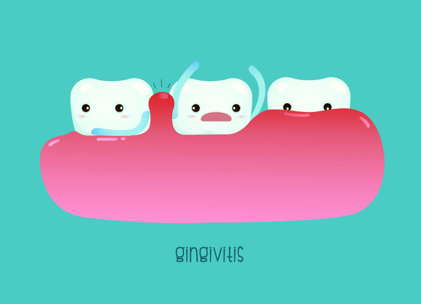 gingivitis gums gengivite gingivite vetorial periodontal dentario vektorn tand orales enfermedades sangue zahnmedizinischen zahnfleischentzündung dentaire muelas dolor periodontics healthrow sufrimiento