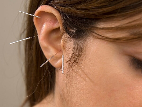 acupuncture for weight loss