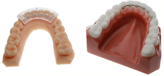 How to clean retainers, types of retainer.