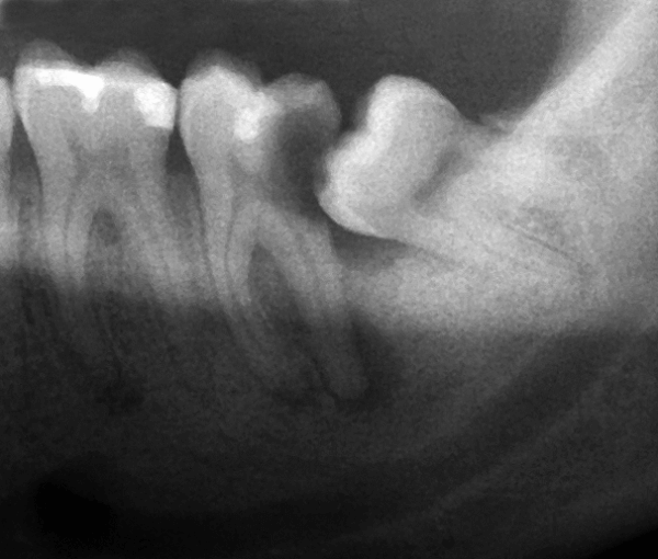 wisdom tooth x-ray swollen gums around wisdom tooth