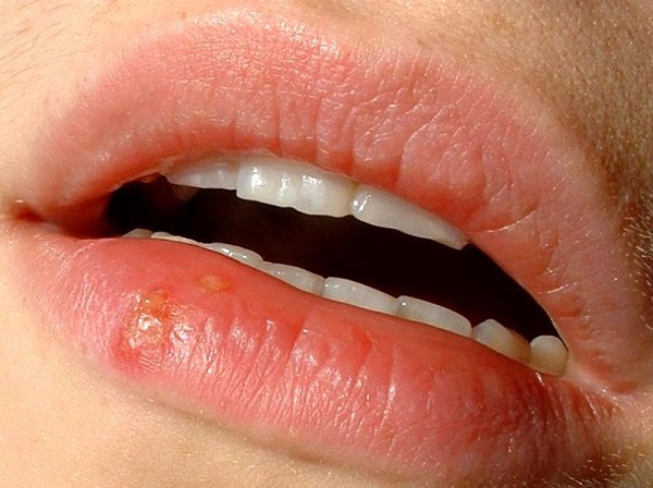 Herpes blister on lip 
