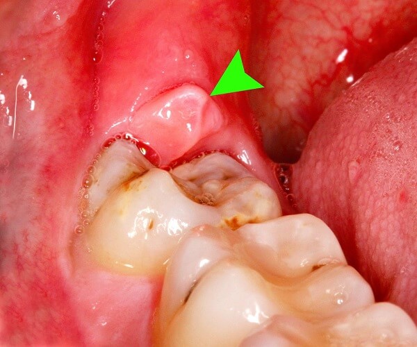 Swollen gums around wisdom tooth