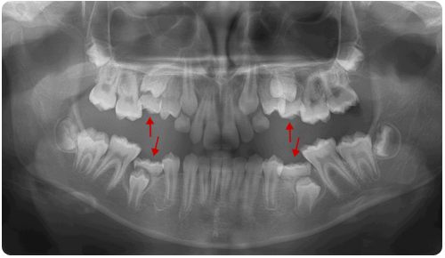 XRay of ankylosed teeth