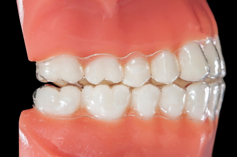 What is a Crossbite or CrossBite?