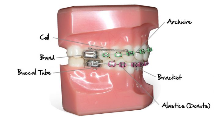 how do braces work