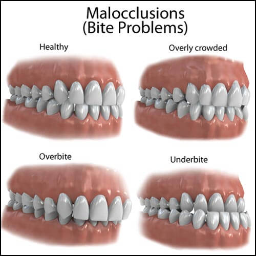 malocclusion types overview