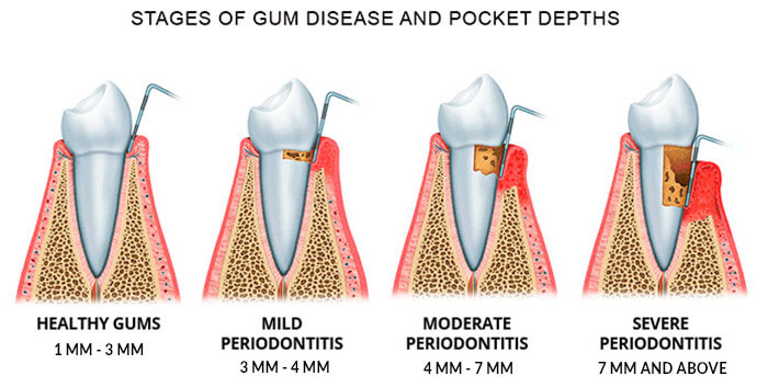 sensitive gums stages of periodontitis