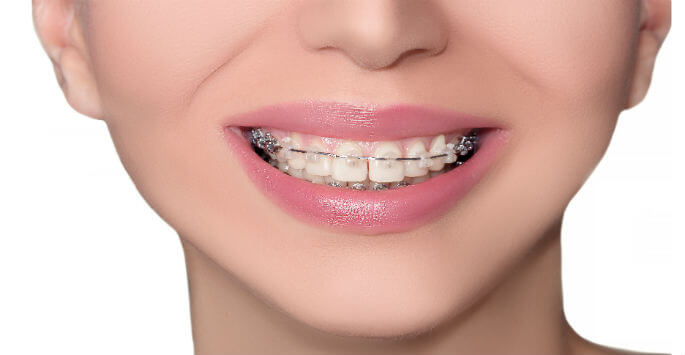 types of braces damon braces