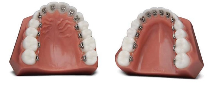 types of braces lingual braces
