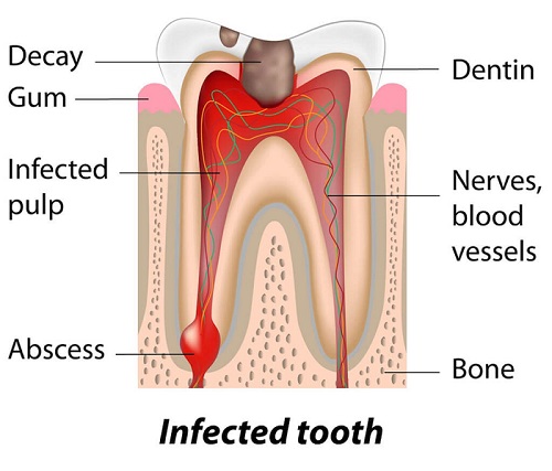 what is a cavity