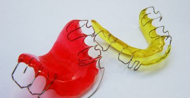 How Long Do I Have to Wear My Retainer?