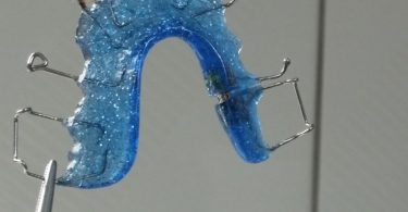 How to Remove Plaque From Your Retainer