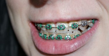 congenitally missing teeth