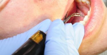 What Causes Periodontal Disease?