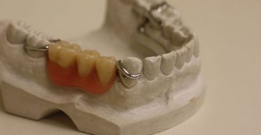 dental implant alternatives