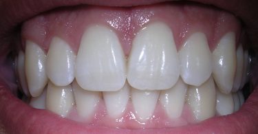 Is Gum Disease Reversible?