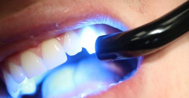 Types of Tooth Fillings