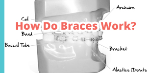 how do braces function