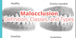 malocclusion
