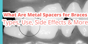 metal spacers braces