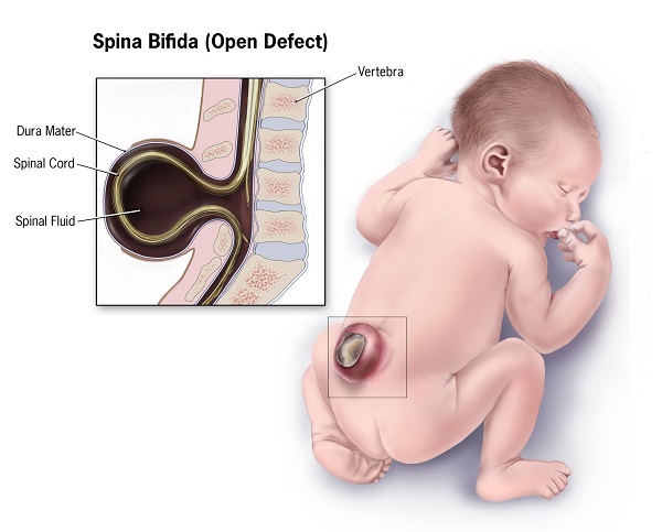 illustration of spina bifida