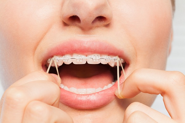woman wearing orthodontic rubber bands