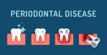 stages of periodontal disease