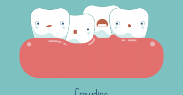 illustration of teeth crowding