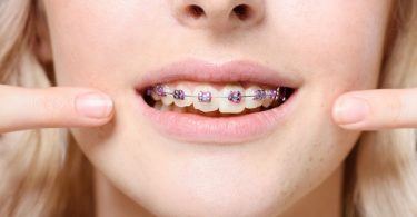 woman pointing at her braces