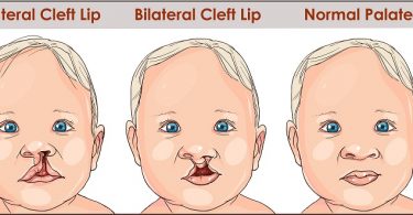 illustration of cleft lip and palate