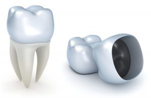 What to Do If Your Temporary Crown Fell Out - Healthrow