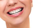 woman smiling and wearing ceramic braces