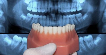lower dental arch mold with a radiography background