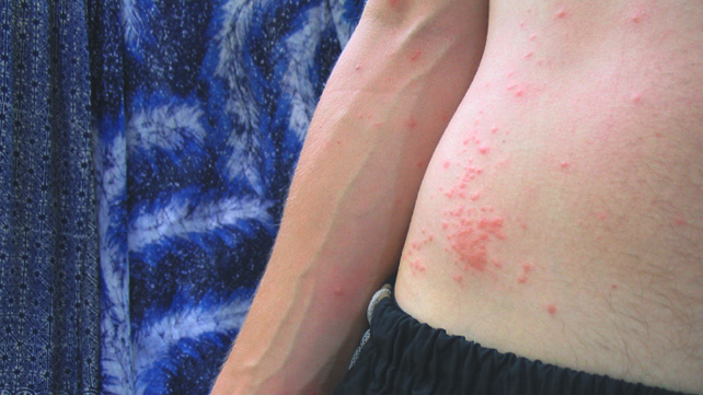  mosquito bites on the skin
