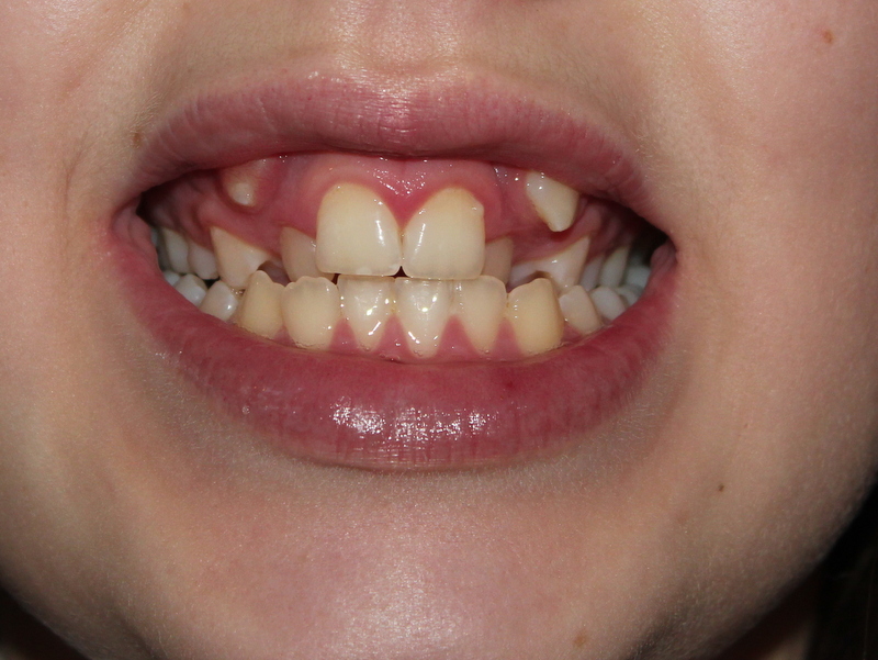 canine teeth