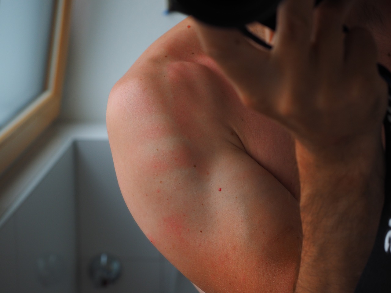 man with red rashes on his arm due to sunburn 